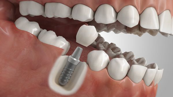 Implantat Einzelzahn Illustration eines Implantats als Ersatz für einen Einzalzahn