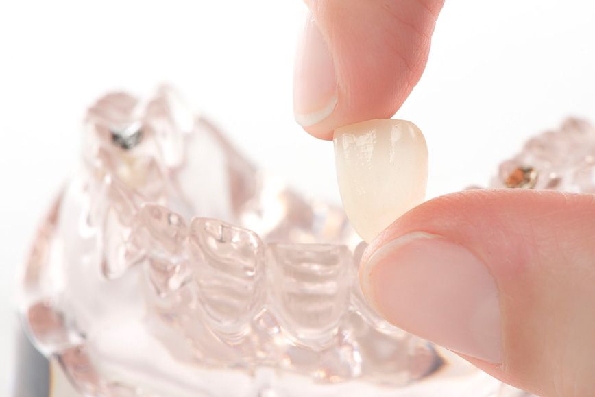 Veneers Veneers