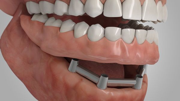 Implantat für Zahnreihen Illustration eines Implantats als Ersatz ganzer Zahnreihen