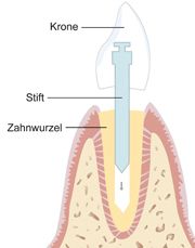 Aufbau einer Stiftkrone Illustration des Aufbaus einer Striftkrone