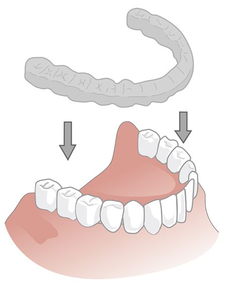 Knirscherschiene Illustration einer Knirscherschiene