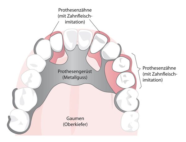 Übersicht Modellgussprothese Illustration einer Modellgussprothese