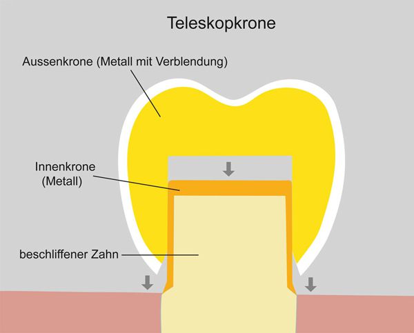 Übersicht Teleskopkrone Illustration einer Teleskopkrone